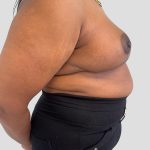 Oncoplastic Breast Reconstruction Before & After Patient #8957