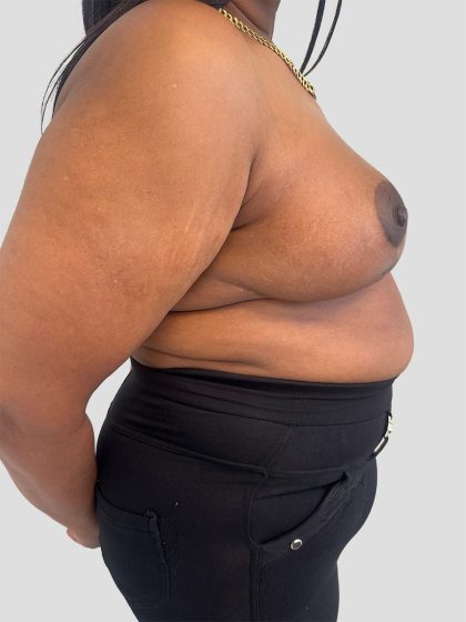 Oncoplastic Breast Reconstruction Before & After Patient #8957
