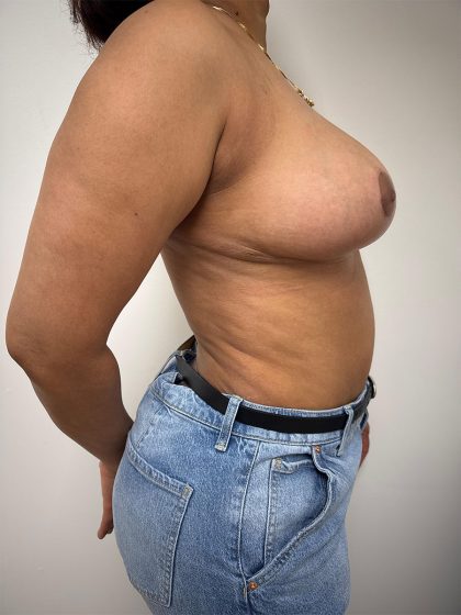 Breast Reduction Before & After Patient #8938