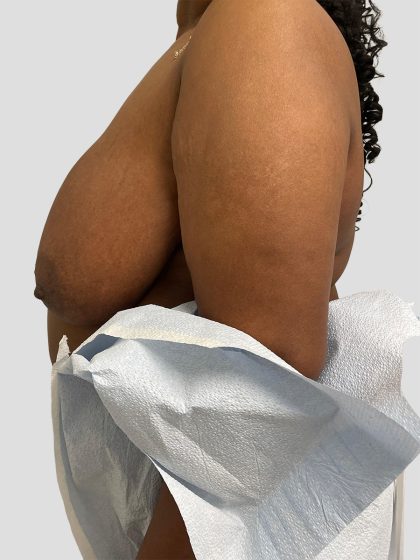 Oncoplastic Breast Reconstruction Before & After Patient #8957
