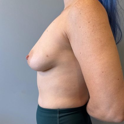 Oncoplastic Breast Reconstruction Before & After Patient #8958