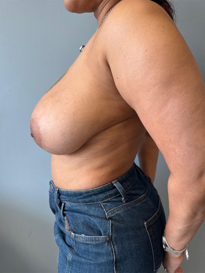 Breast Reduction Before & After Patient #8938