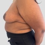 Oncoplastic Breast Reconstruction Before & After Patient #8957
