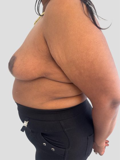 Oncoplastic Breast Reconstruction Before & After Patient #8957