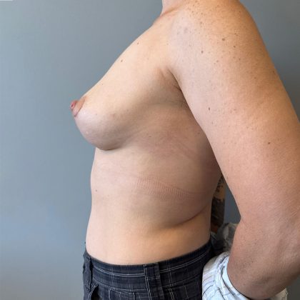 Oncoplastic Breast Reconstruction Before & After Patient #8958