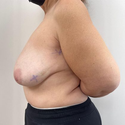 Breast Reconstruction Before & After Patient #8946