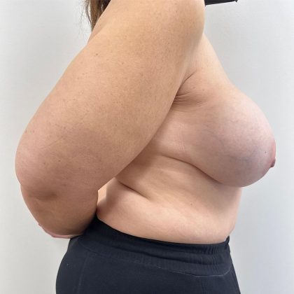 Breast Reconstruction Before & After Patient #8946