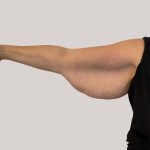 Arm Lift Before & After Patient #8976