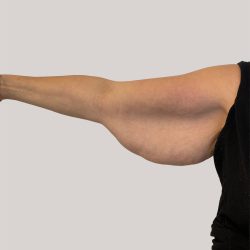Arm Lift Before & After Patient #8976