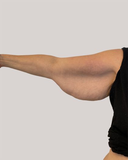 Arm Lift Before & After Patient #8976