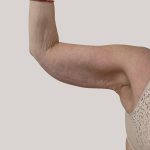 Arm Lift Before & After Patient #8976