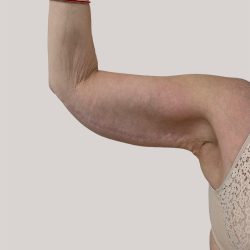 Arm Lift Before & After Patient #8976