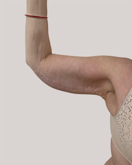 Arm Lift Before & After Patient #8976