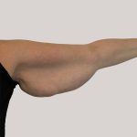 Arm Lift Before & After Patient #8976