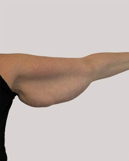 Arm Lift Before & After Patient #8976