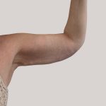 Arm Lift Before & After Patient #8976