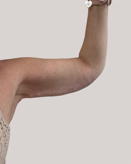 Arm Lift Before & After Patient #8976