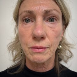 Facelift Before & After Patient #8982