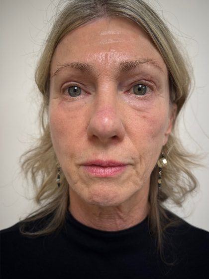 Facelift Before & After Patient #8982