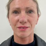 Facelift Before & After Patient #8982