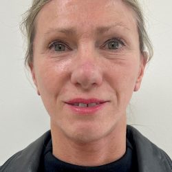 Facelift Before & After Patient #8982