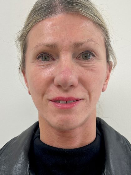 Facelift Before & After Patient #8982